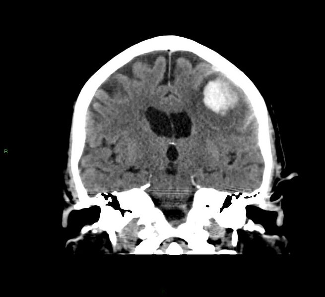 File:Cerebral amyloid angiopathy-associated lobar intracerebral hemorrhage (Radiopaedia 58376-65511 Coronal non-contrast 34).jpg