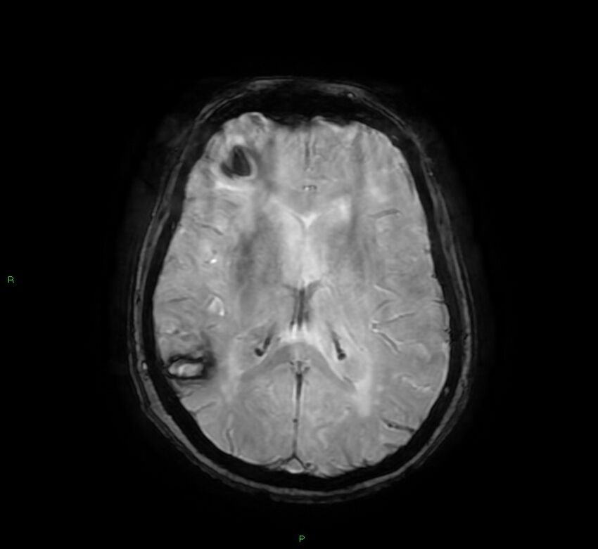 Cerebral amyloid angiopathy-associated lobar intracerebral hemorrhage (Radiopaedia 58378-65517 Axial SWI 41).jpg