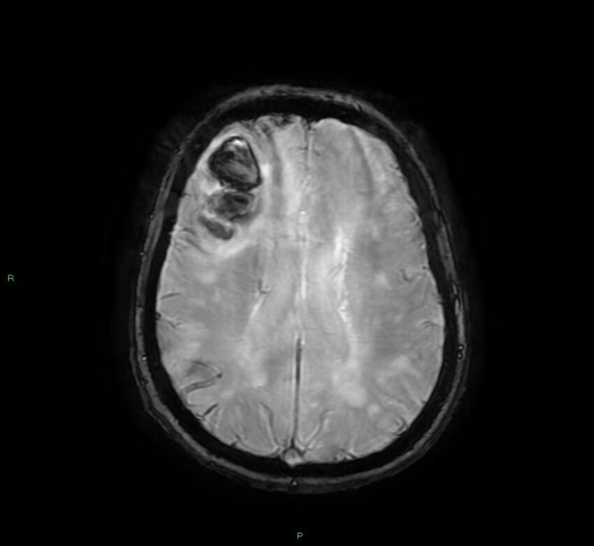 Cerebral amyloid angiopathy-associated lobar intracerebral hemorrhage (Radiopaedia 58378-65517 Axial SWI 47).jpg