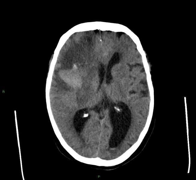 File:Cerebral amyloid angiopathy-associated lobar intracerebral hemorrhage (Radiopaedia 58560-65723 Axial non-contrast 27).jpg