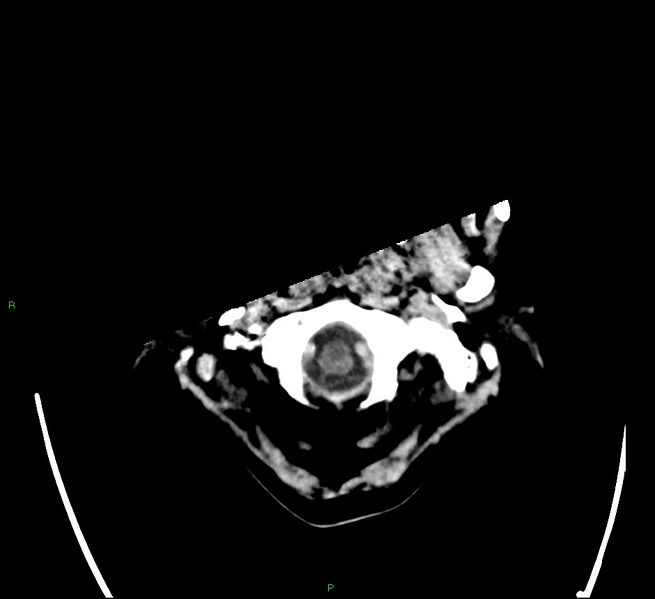 File:Cerebral amyloid angiopathy-associated lobar intracerebral hemorrhage (Radiopaedia 58566-65731 Axial non-contrast 1).jpg