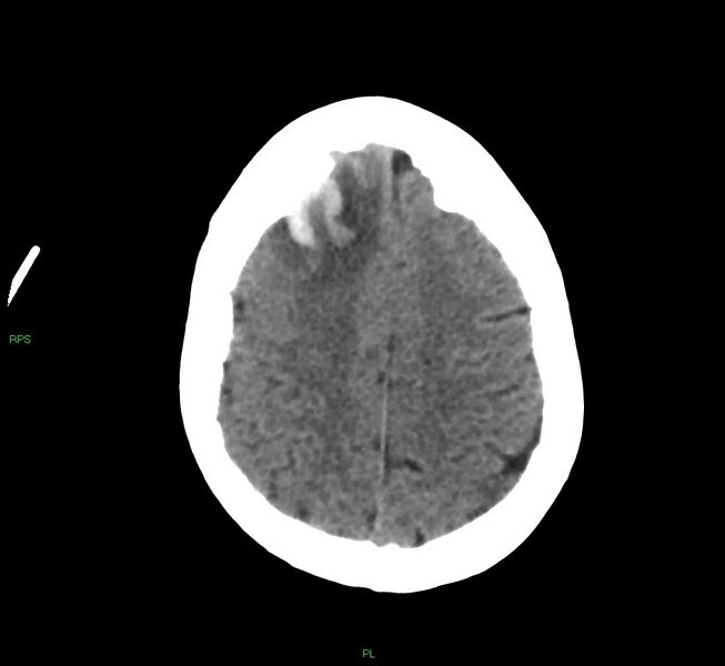 File:Cerebral amyloid angiopathy-associated lobar intracerebral hemorrhage (Radiopaedia 58569-65734 Axial non-contrast 20).jpg