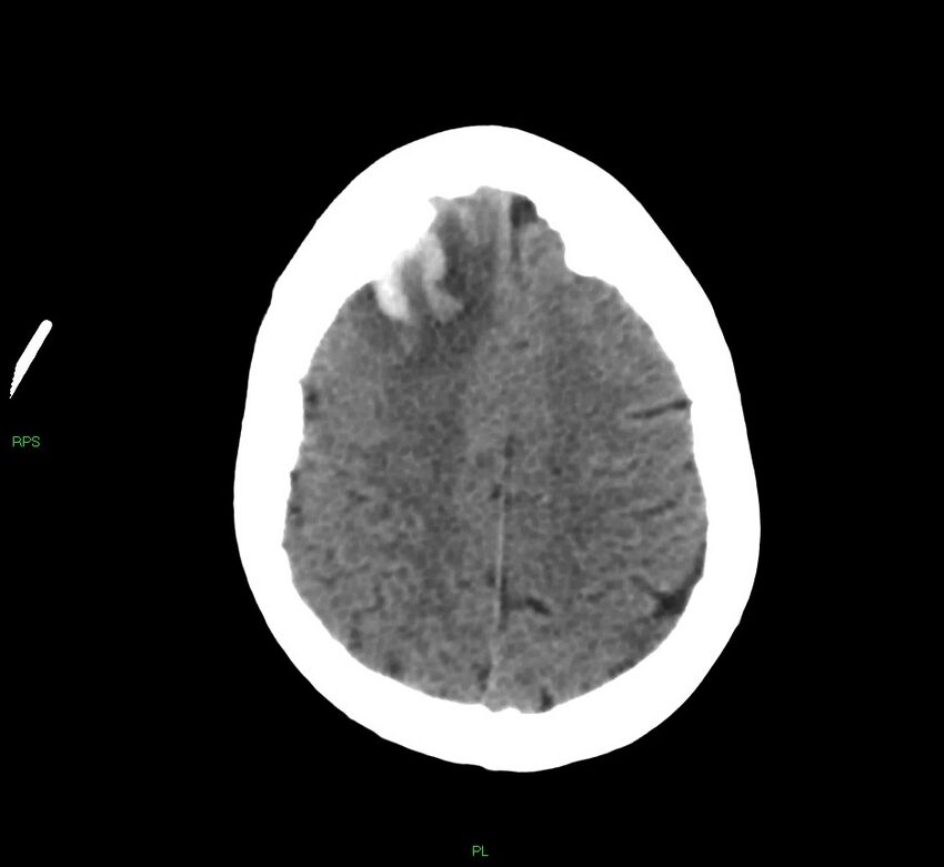 Cerebral amyloid angiopathy-associated lobar intracerebral hemorrhage (Radiopaedia 58569-65734 Axial non-contrast 20).jpg
