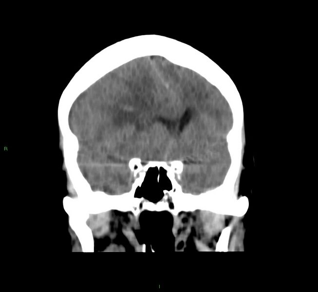 File:Cerebral amyloid angiopathy-associated lobar intracerebral hemorrhage (Radiopaedia 58751-65972 Coronal non-contrast 40).jpg
