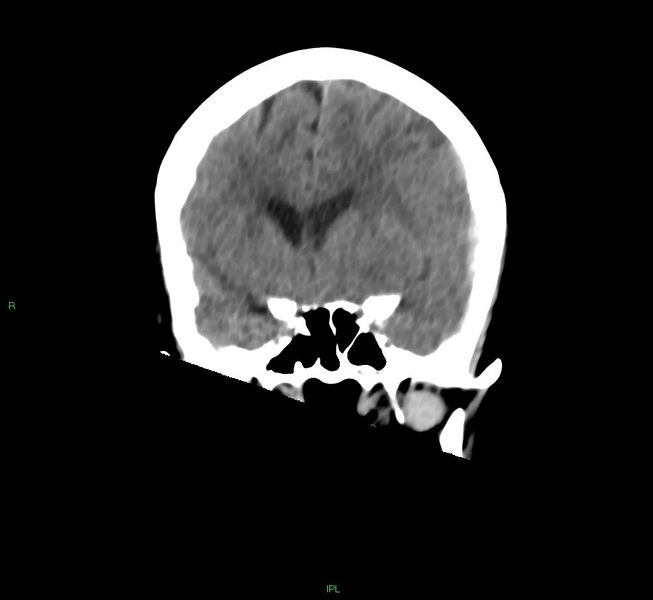 File:Cerebral amyloid angiopathy-associated lobar intracerebral hemorrhage (Radiopaedia 58754-65975 Coronal non-contrast 41).jpg