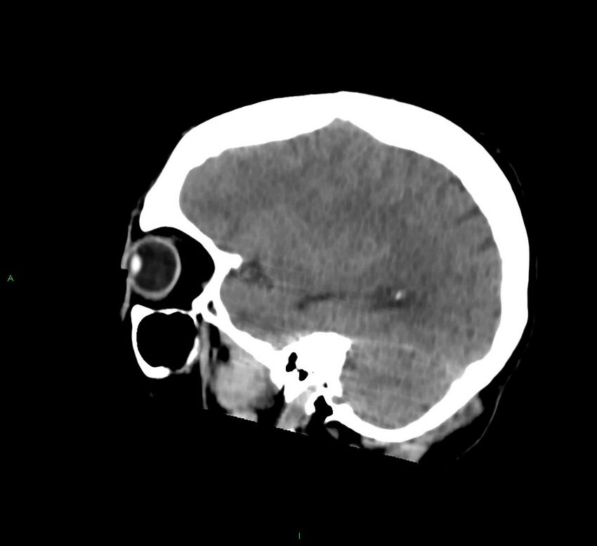 Cerebral amyloid angiopathy-associated lobar intracerebral hemorrhage (Radiopaedia 58756-65977 C 42).jpg