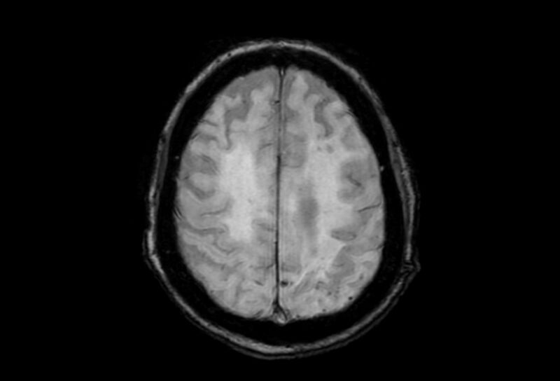 File:Cerebral amyloid angiopathy (Radiopaedia 86671-102792 Axial Gradient Echo 13).jpg