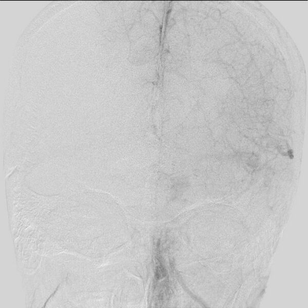 File:Cerebral aneurysm with rupture (Radiopaedia 29933-30458 LT ICA IC 21).jpg