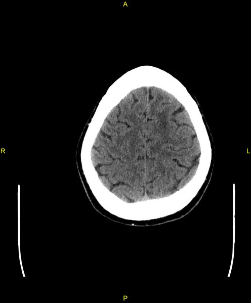 File:Cerebral autosomal dominant arteriopathy with subcortical infarcts and leukoencephalopathy (CADASIL) (Radiopaedia 86108-102051 Axial non-contrast 94).jpg