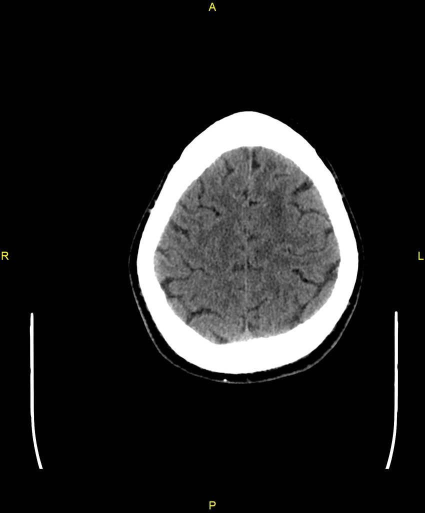 Cerebral autosomal dominant arteriopathy with subcortical infarcts and leukoencephalopathy (CADASIL) (Radiopaedia 86108-102051 Axial non-contrast 94).jpg