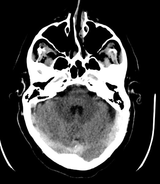 File:Cerebral dural venous sinus thrombosis (Radiopaedia 86514-102575 Axial non-contrast 12).jpg