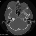 Cerebral hemorrhagic contusion with subdural and subarachnoid hemorrhage (Radiopaedia 10680-11146 Axial bone window 9).jpg