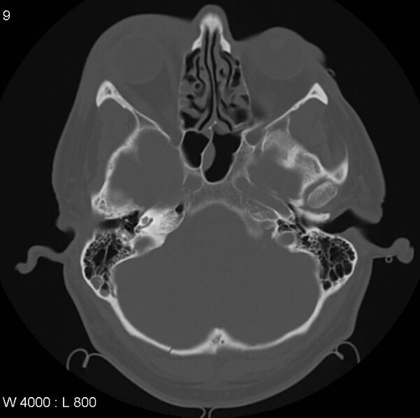 File:Cerebral hemorrhagic contusion with subdural and subarachnoid hemorrhage (Radiopaedia 10680-11146 Axial bone window 9).jpg
