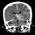 Cerebral hemorrhagic contusions (Radiopaedia 23145-23188 Coronal non-contrast 28).jpg