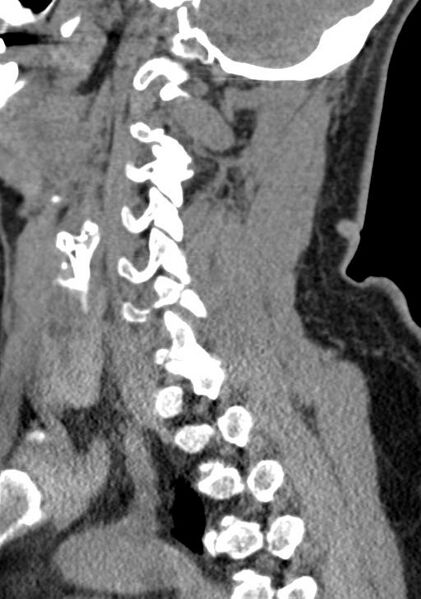 File:Cerebral hemorrhagic contusions and cervical spine fractures (Radiopaedia 32865-33841 G 43).jpg