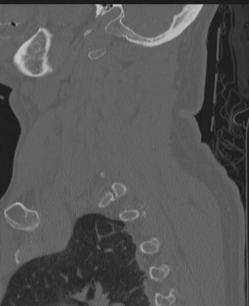 File:Cerebral hemorrhagic contusions and cervical spine fractures (Radiopaedia 32865-33841 Sagittal bone window 77).jpg