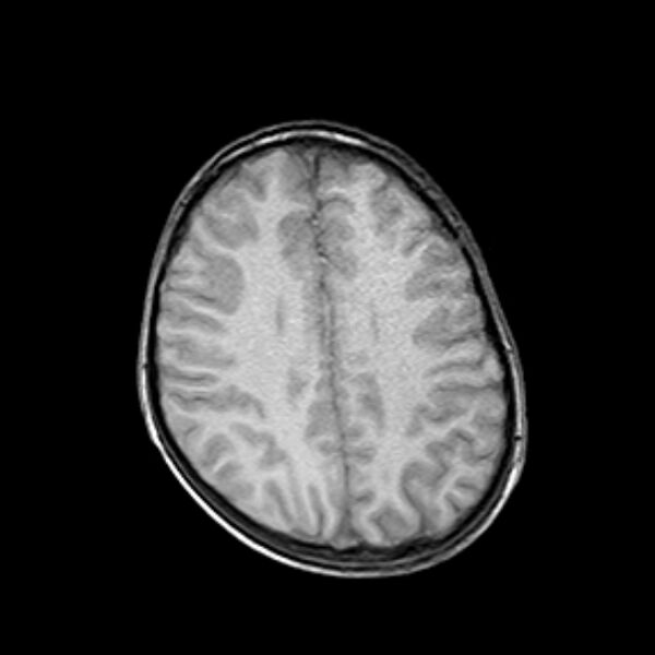 File:Cerebral tuberculoma (Radiopaedia 41152-43932 Axial T1 16).jpg