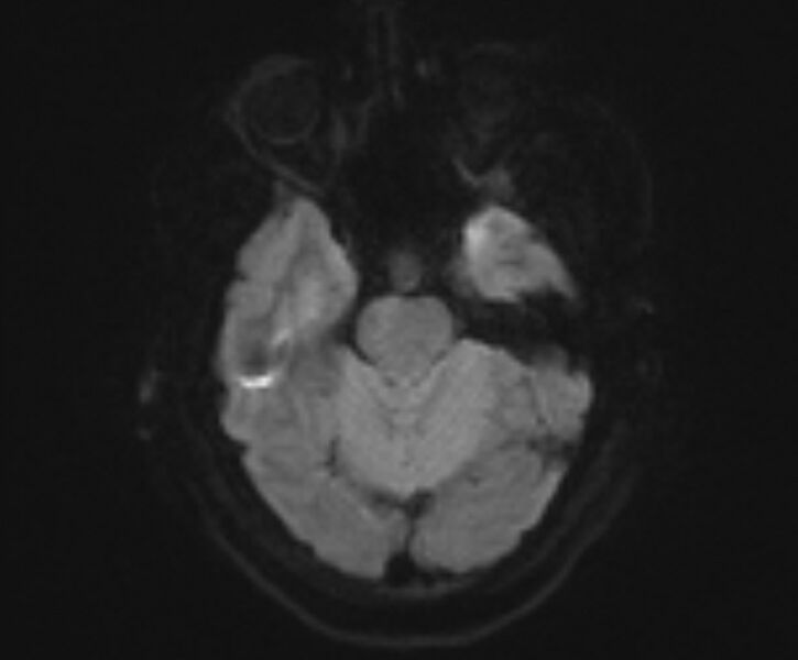 File:Cerebral venous infarct (Radiopaedia 53627-59685 Axial DWI 4).jpg