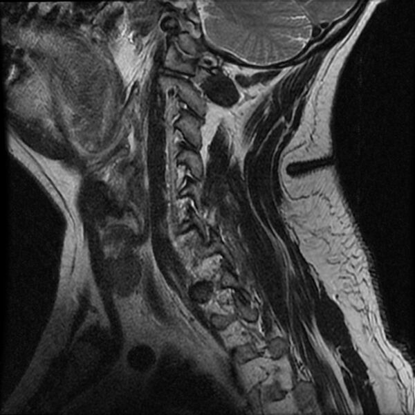 File:Cervical fracture and dislocation with locked facet (Radiopaedia 31837-32781 Sagittal T2 2).jpg