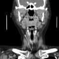 Cervical lymphadenopathy- cause unknown (Radiopaedia 22420-22457 C 14).jpg