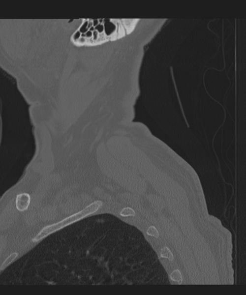 File:Cervical spine fracture in the setting of ankylosis (Radiopaedia 37038-38715 Sagittal bone window 2).png