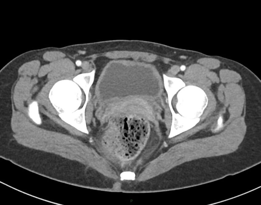 Cesarean scar endometriosis (Radiopaedia 82925-97262 A 82).jpg