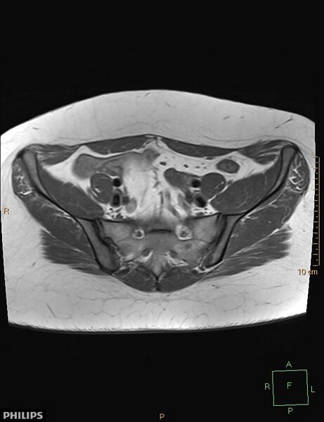File:Cesarian scar endometriosis (Radiopaedia 68495-78066 Axial T1 4).jpg