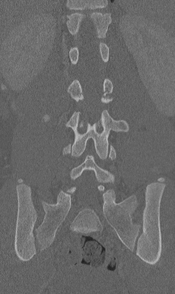File:Chance fracture (Radiopaedia 40360-42912 Coronal bone window 43).png