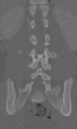 Chance fracture (Radiopaedia 40360-42912 Coronal bone window 43).png