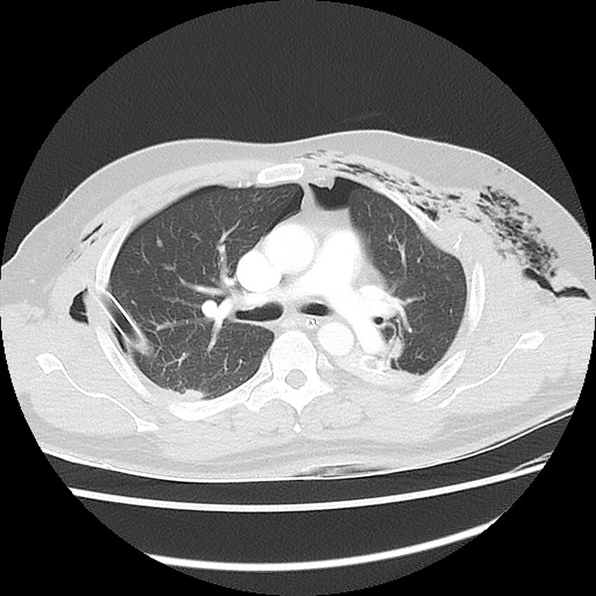 Chest crush injury (Radiopaedia 31620-32513 Axial lung window 24).jpg