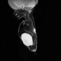 Chiari II malformation with spinal meningomyelocele (Radiopaedia 23550-23652 Sagittal T2 4).jpg