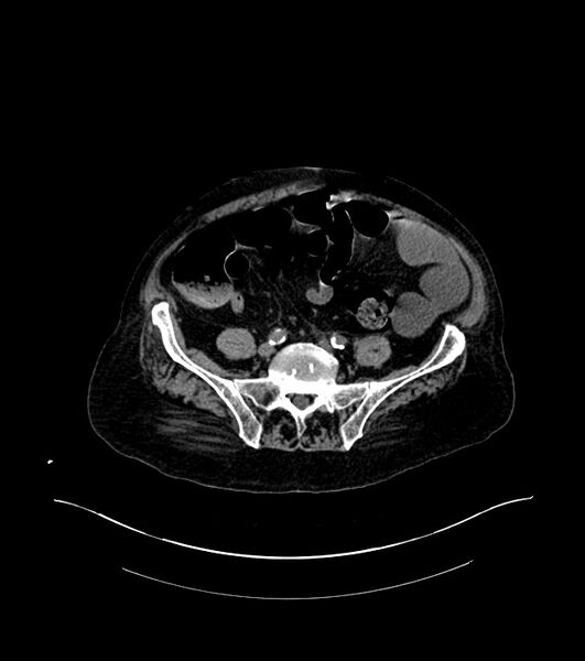 File:Cholangiocarcinoma with cerebral metastases (Radiopaedia 83519-98629 Axial non-contrast 88).jpg