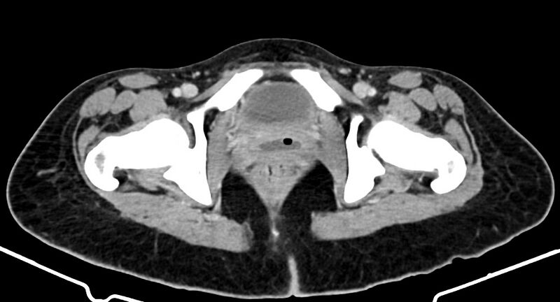 File:Choriocarcinoma liver metastases (Radiopaedia 74768-85766 A 201).jpg