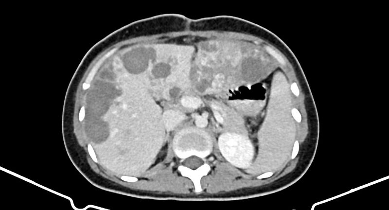File:Choriocarcinoma liver metastases (Radiopaedia 74768-85766 A 75).jpg