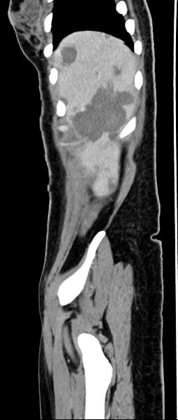 File:Choriocarcinoma liver metastases (Radiopaedia 74768-85766 C 148).jpg