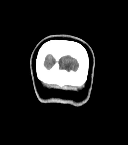 File:Choroid plexus carcinoma (Radiopaedia 91013-108552 Coronal non-contrast 85).jpg