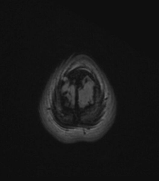 File:Choroid plexus carcinoma (Radiopaedia 91013-108553 Axial FLAIR C+ 199).jpg
