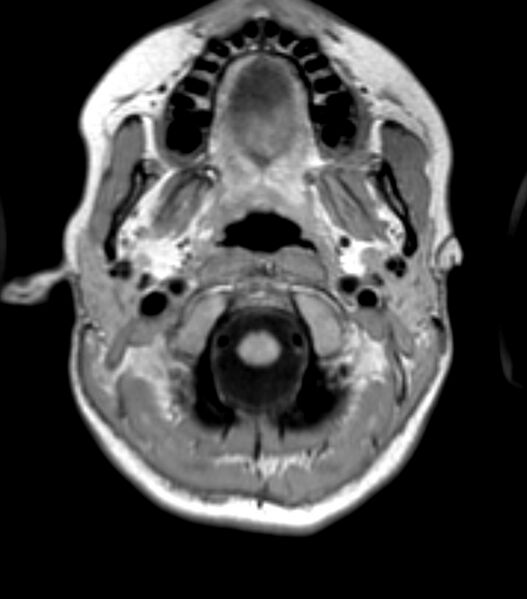 File:Choroid plexus carcinoma (Radiopaedia 91013-108553 Axial T1 26).jpg