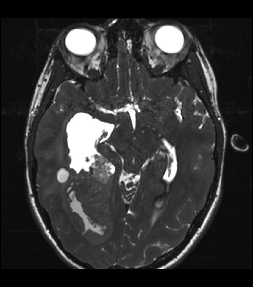 Choroid plexus carcinoma (Radiopaedia 91013-108553 Axial T2 CISS 23).jpg