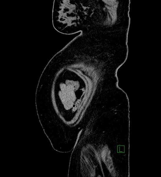 File:Chromophobe renal cell carcinoma (Radiopaedia 84239-99519 G 9).jpg