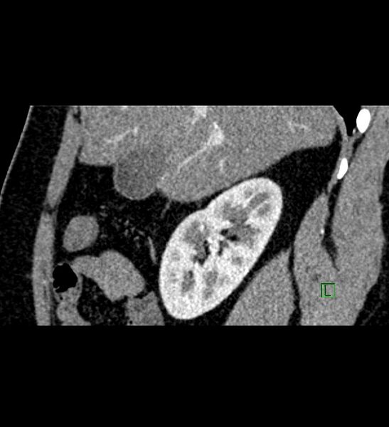 File:Chromophobe renal cell carcinoma (Radiopaedia 84286-99573 F 122).jpg