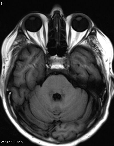 File:Chronic lymphocytic inflammation with pontine perivascular enhancement responsive to steroids (CLIPPERS) (Radiopaedia 37520-39374 Axial T1 5).jpg