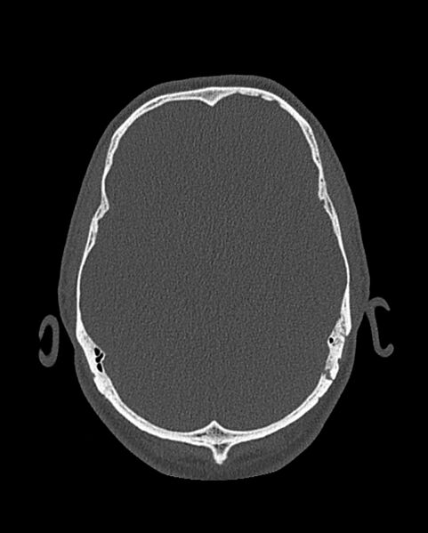 File:Chronic maxillary sinusitis caused by a foreign body (Radiopaedia 58521-65676 Axial bone window 320).jpg