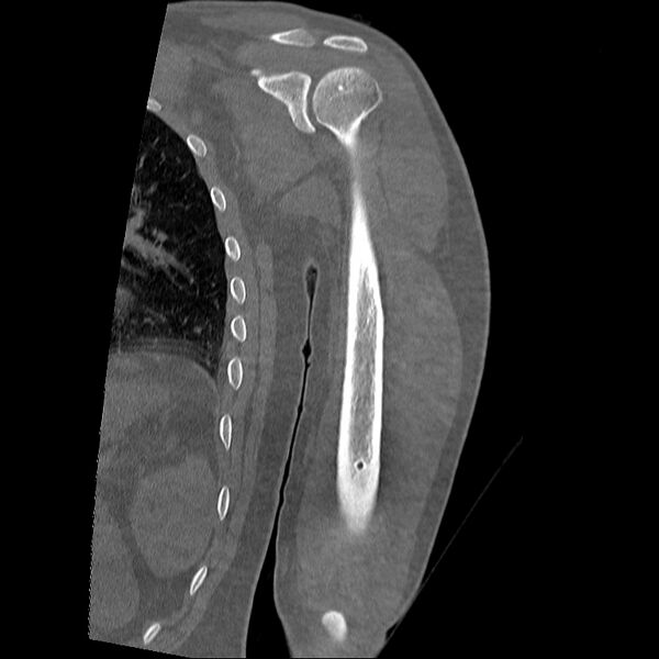File:Chronic osteomyelitis (Radiopaedia 67597-76998 Coronal bone window 13).jpg