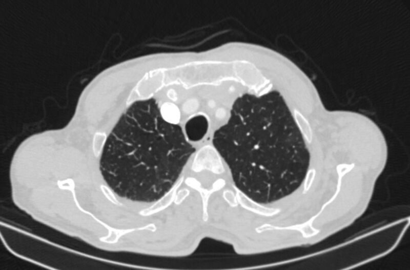 File:Chronic pulmonary embolism (Radiopaedia 91241-108843 Axial lung window 14).jpg