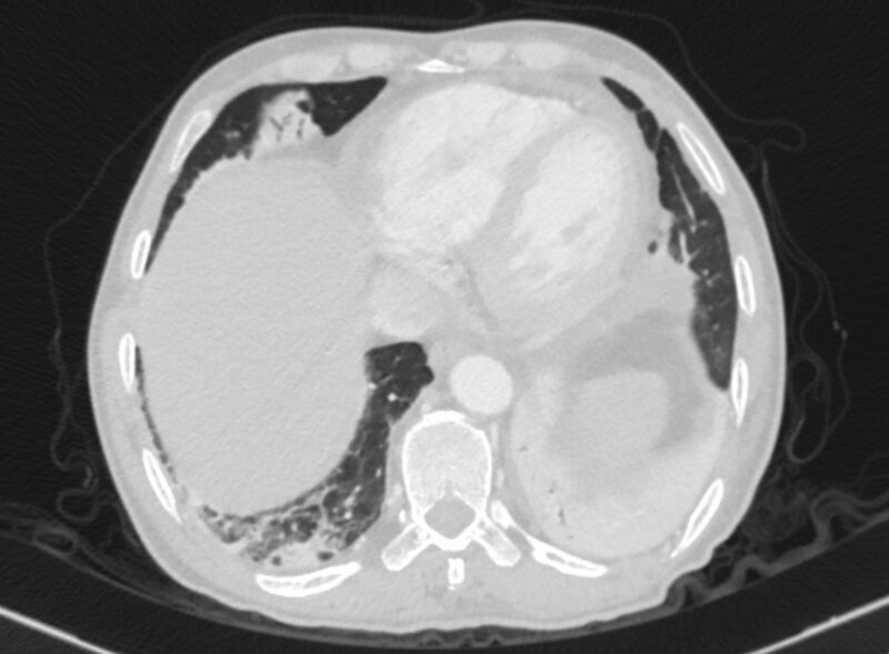 File:Chronic pulmonary embolism with bubbly consolidation (Radiopaedia 91248-108850 Axial lung window 125).jpg