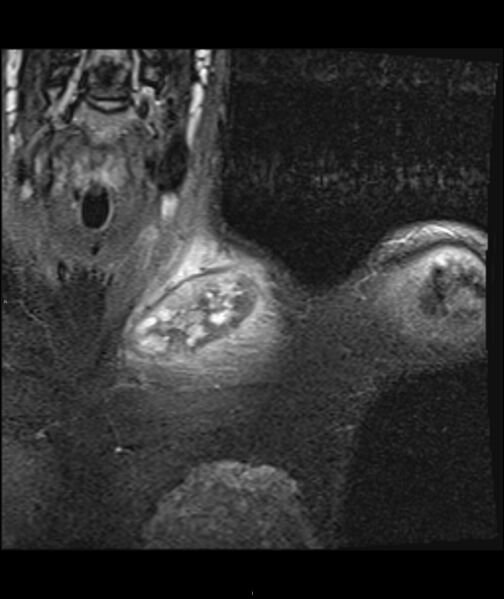 File:Chronic reactive multifocal osteomyelitis (CRMO) - clavicle (Radiopaedia 56406-63071 Coronal STIR 10).jpg