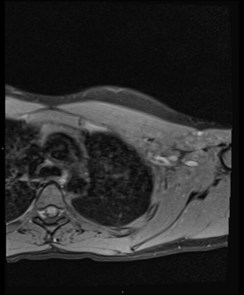 File:Chronic reactive multifocal osteomyelitis (CRMO) - clavicle (Radiopaedia 56406-63114 Axial T1 fat sat 18).jpg