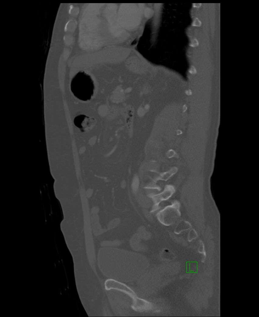 Clear cell renal cell carcinoma (Radiopaedia 85006-100539 Sagittal bone window 25).jpg