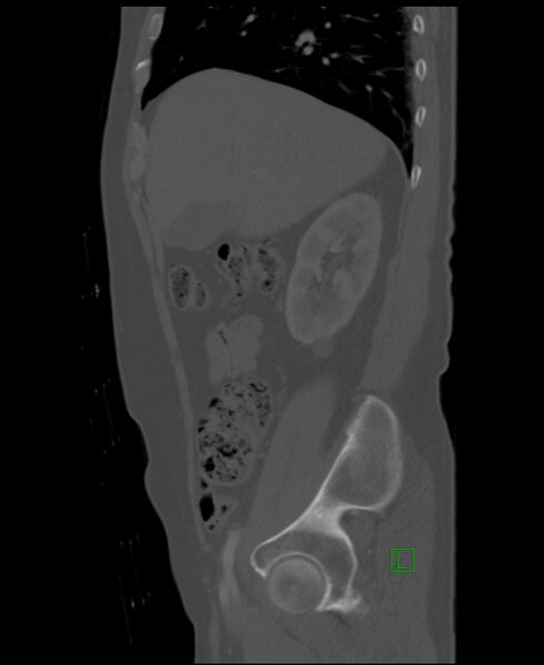 File:Clear cell renal cell carcinoma (Radiopaedia 85006-100539 Sagittal bone window 44).jpg
